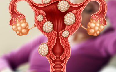 Mioma é um tipo de câncer?