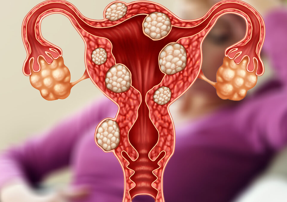 Imagem Mioma é um tipo de câncer?